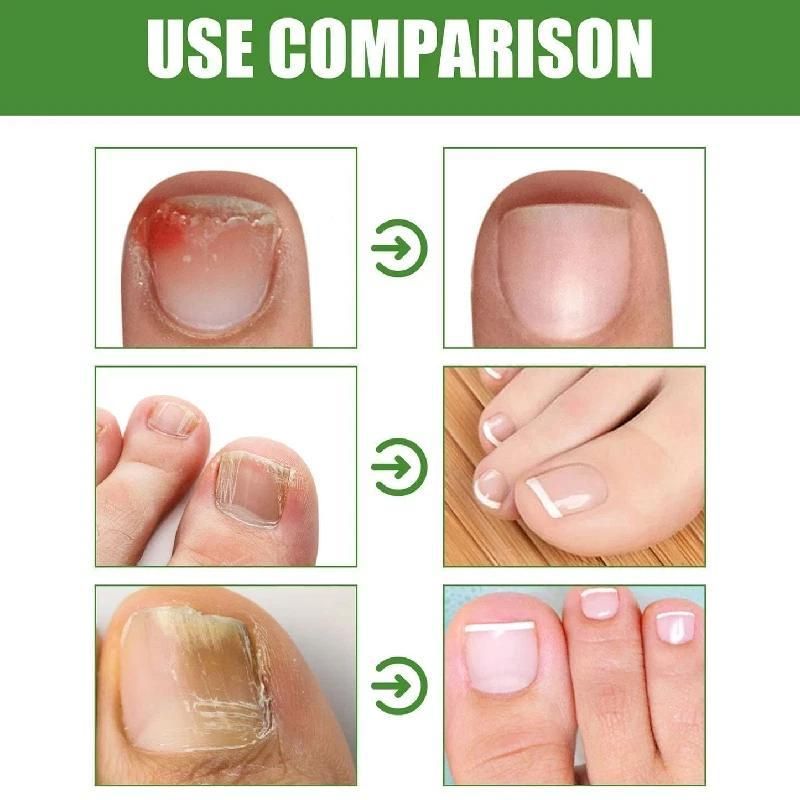 Nail Shield Serum Anti Fungal Stick Roll On 10ml